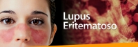 6 Manifestaciones del Lupus Eritematoso Sistémico