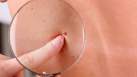 ¿Cuáles son los 3 tipos de cáncer de piel?